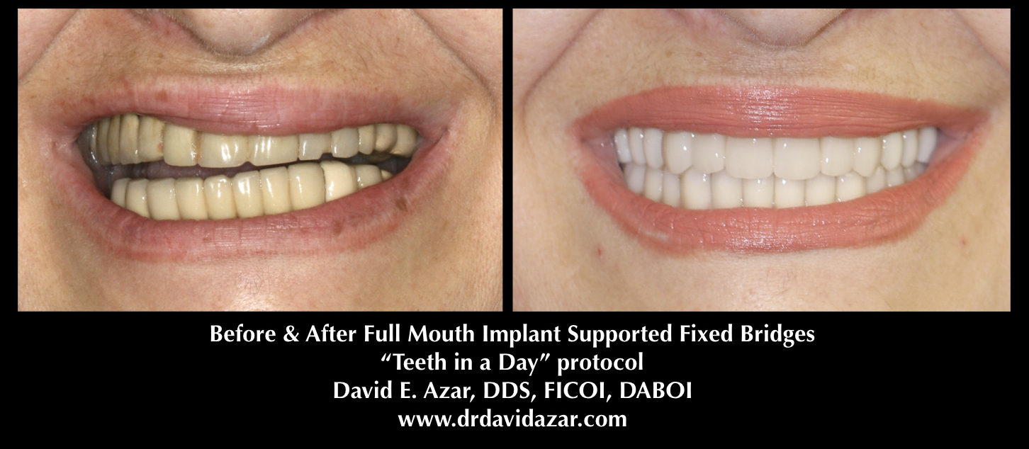 Dental Implants in Financial District